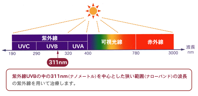 紫外線UVBの中の311nm(ナノメートル)を中心とした狭い範囲(ナローバンド)の波長
の紫外線を用いて治療します。